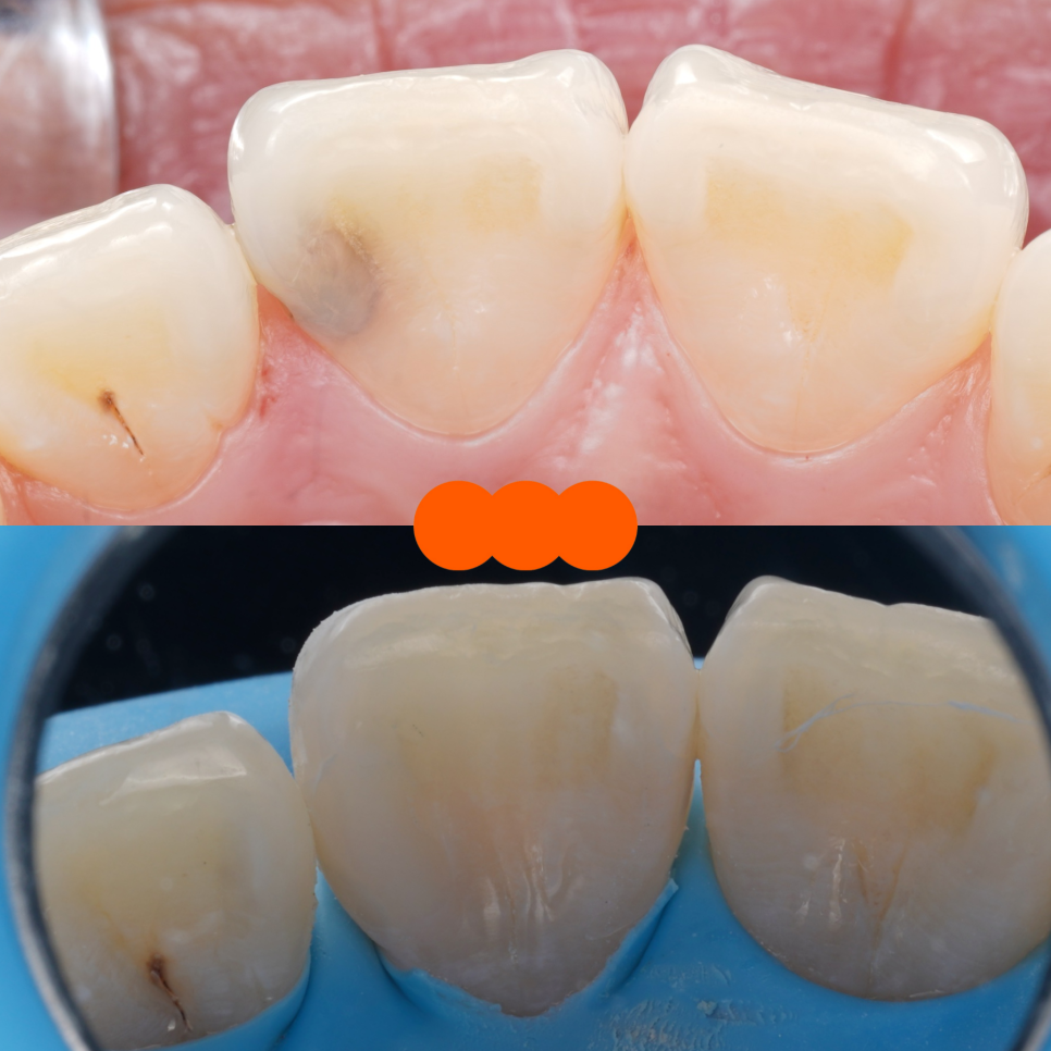 교대역치과 타치과 신경치료, 크라운 진단받았으나 레진으로 치료 관련 이미지 10