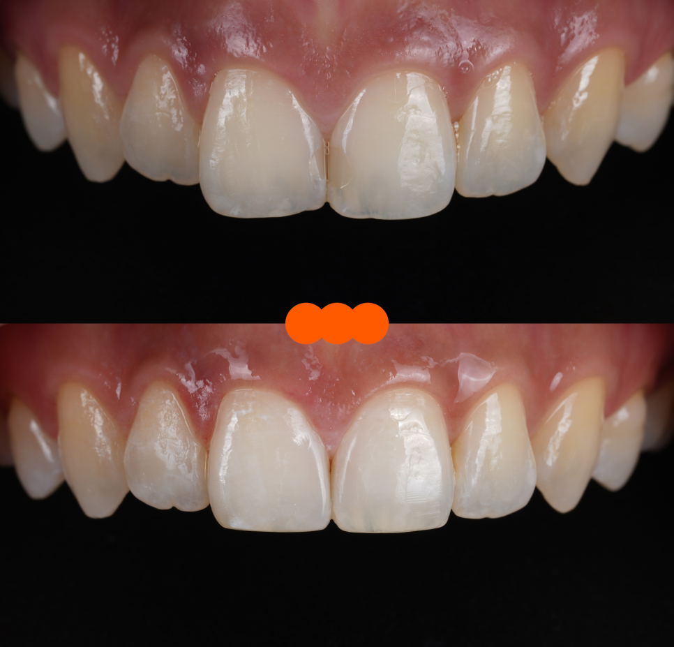 앞니사이충치 레진으로 치아성형 효과까지 낼 수 있어요 관련 이미지 9