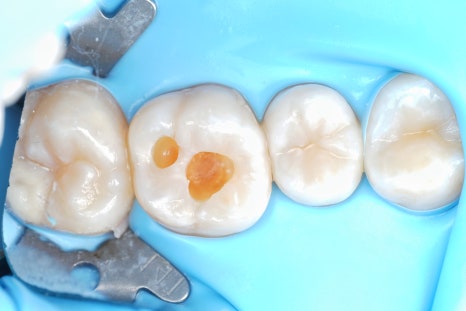 교대역 충치, 신경치료 회피하는 레진빌드업 치과이야기 관련 이미지 3