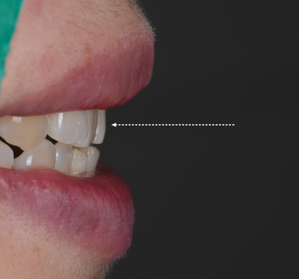 Gangnam Dental Clinic: Resin Restoration Process for a Chipped Front Tooth Considering Tooth Position image 4