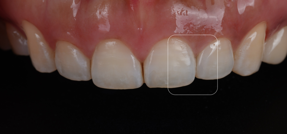 서초구치과 치아 사이 삭제 부작용과 치료법 관련 이미지 13