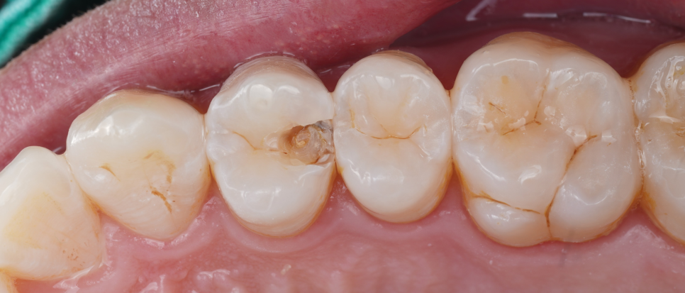 강남역치과 치료 부위 2차 충치 레진 재치료 사례 관련 이미지 5