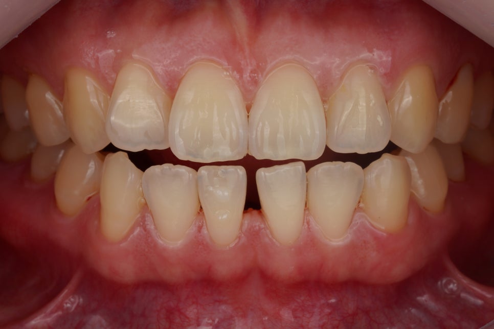 앞니 벌어짐 레진 당일 치료, 앞니 레진 잘하는 서초동 치과 관련 이미지 4