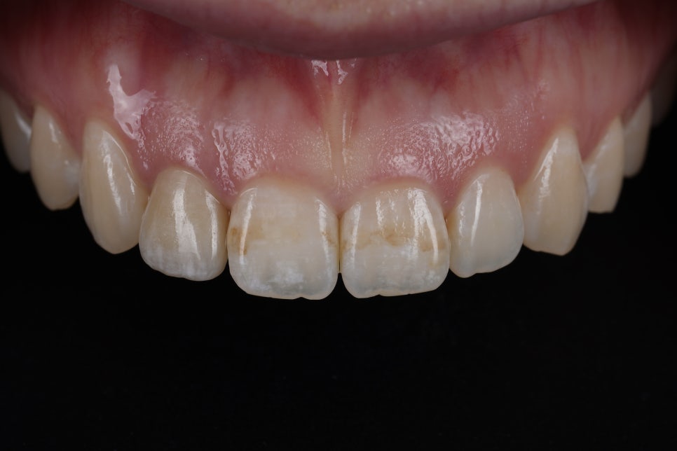 앞니 갈색 반점, 무삭제로 얼룩 제거 시술 : 아이콘 침투 관련 이미지 1