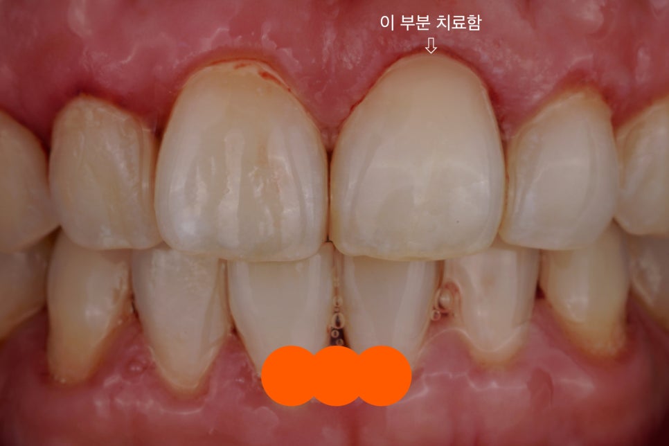 치아 패임 치경부 충치 레진 잘하는 서초동 치과 관련 이미지 3