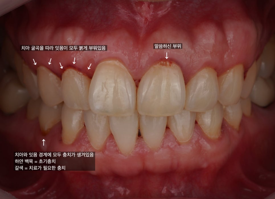 치아 패임 치경부 충치 레진 잘하는 서초동 치과 관련 이미지 1