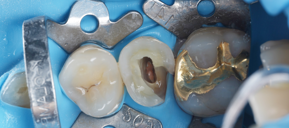 신경치료 후 크라운 안 하고 레진으로 할 수 있어요 관련 이미지 7