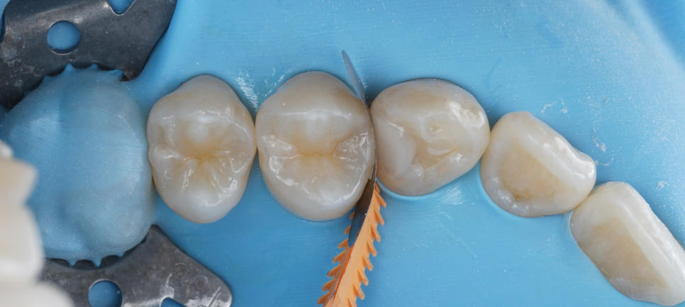 역삼역 치과 치대생 깊은 충치 신경치료없이 레진으로 완료 관련 이미지 14