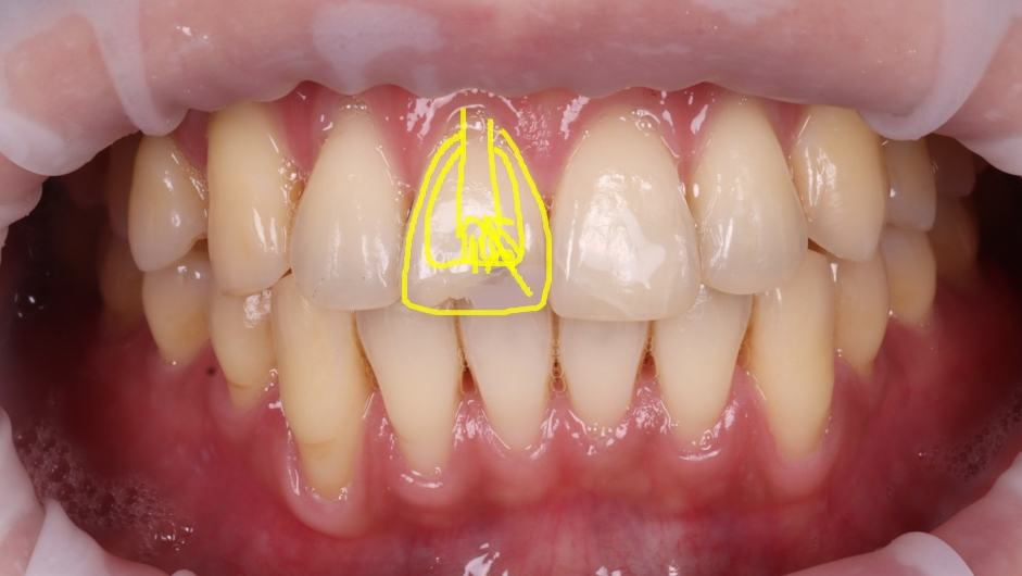 강남역치과 앞니 파절 크라운 말고 레진으로 하세요 관련 이미지 6