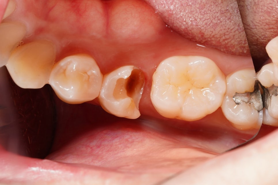 교대역 충치 치과, 신경치료 진단은 보수적으로 접근합니다. 관련 이미지 3