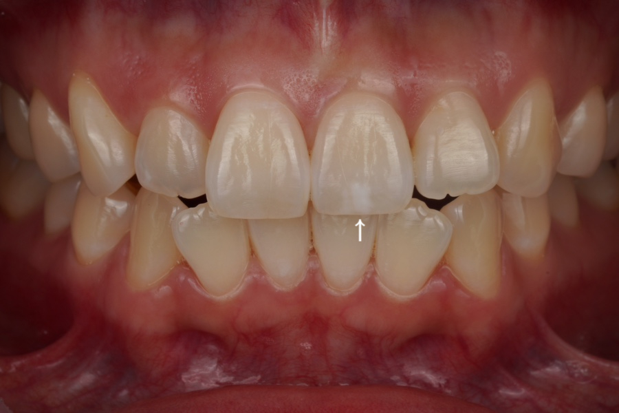 서초동 반점치 레진, 웨딩 촬영 전 앞니 치과치료 관련 이미지 1