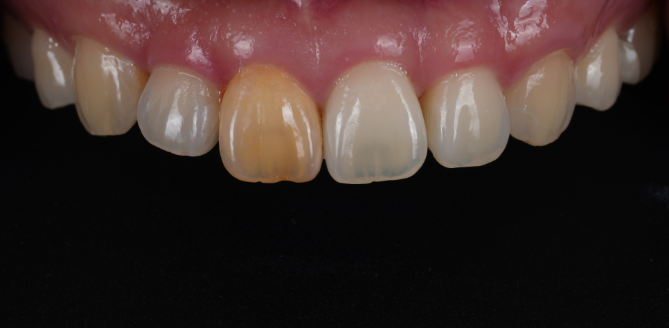 서초치과 5년간 14개 치과 돌다 본원에서 정착한 이유는? 관련 이미지 1