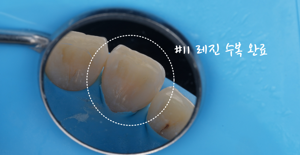 교대역치과 타치과 신경치료, 크라운 진단받았으나 레진으로 치료 관련 이미지 7