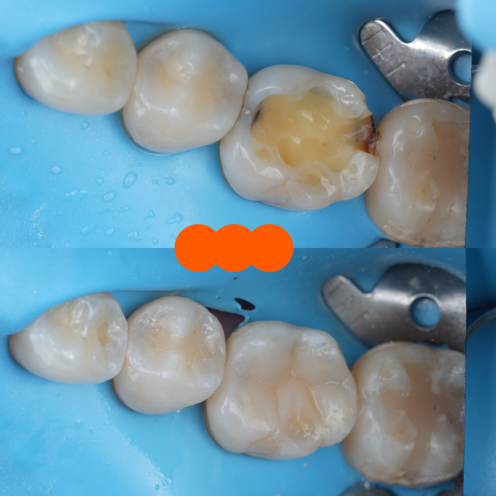 교대역 치과 보철 아래 2차 충치를 다시 레진으로 관련 이미지 29