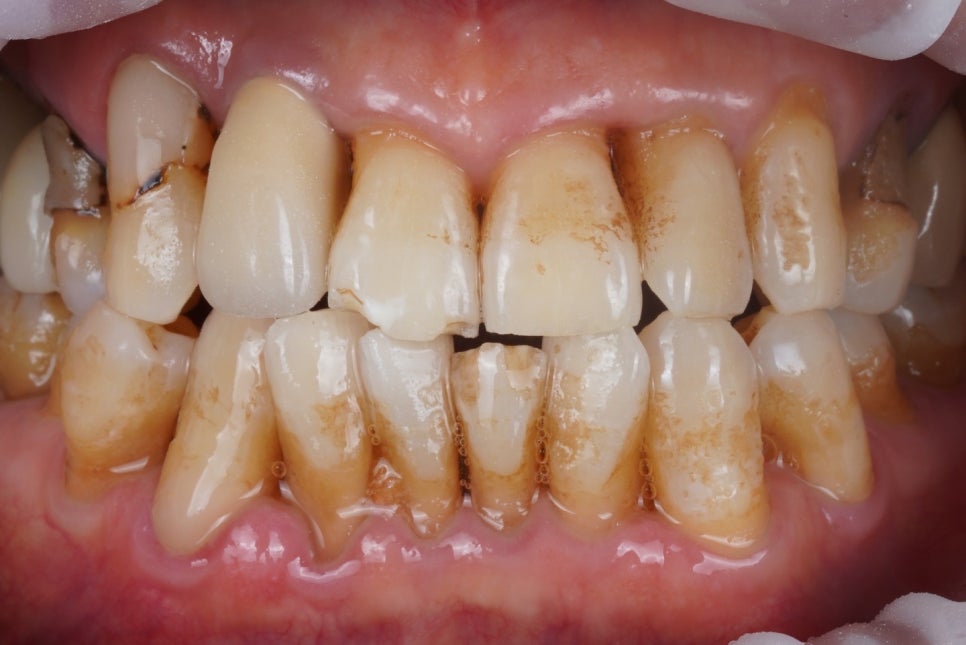 50~60대 잇몸 염증 치료는 주기적인 스케일링부터 시작입니다. 관련 이미지 1