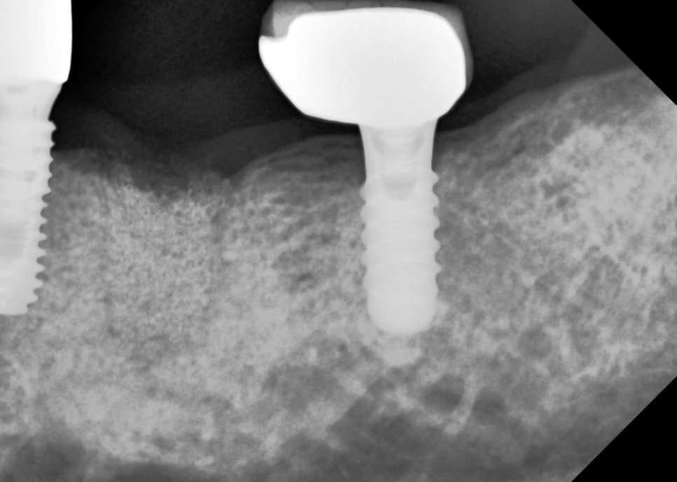 잇몸뼈 녹음, 뼈이식으로 부족한 잇몸 강화 후 기다리는 이유 관련 이미지 3