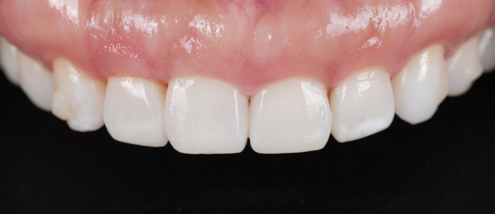 신사역치과 미국에서 교정 중이던 분 앞니 레진으로 고민 해결 관련 이미지 11