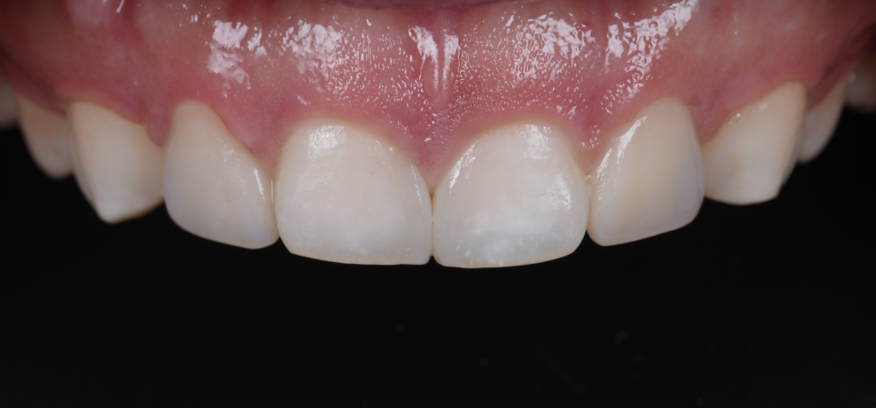 앞니 왜소치 레진 치과의사 소개로 내원해 당일 완료 관련 이미지 11