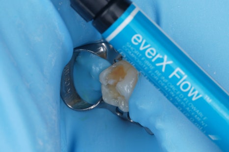 Jamnwon-dong Dental Clinic: Don’t Grind Down Your Teeth—Get Resin Build-up Instead image 8