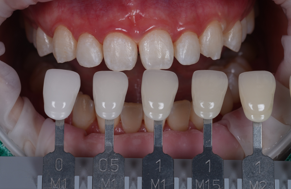앞니 벌어짐 레진 비니어 후 미인대회 출전 관련 이미지 9