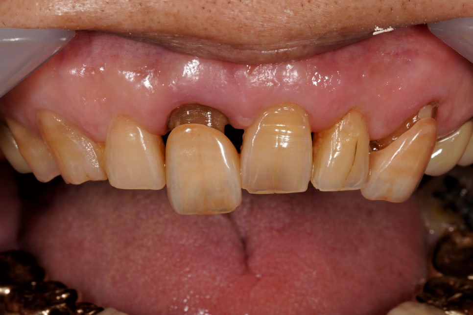 앞니 크라운 브릿지 재치료 시 이럴 땐 따로 제작해야 돼요 관련 이미지 4