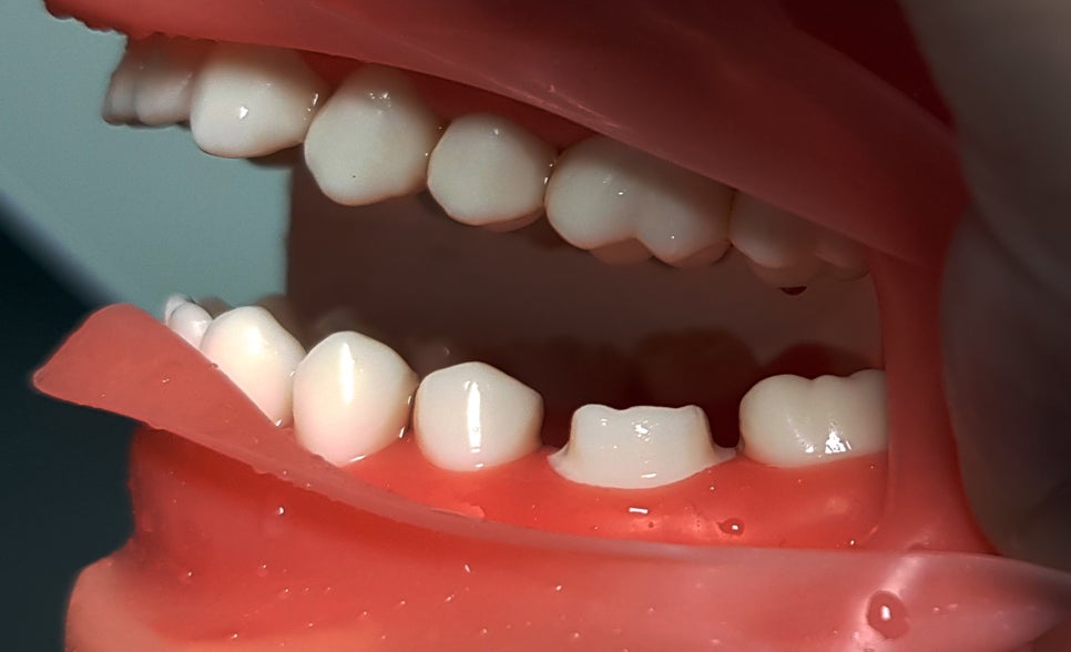 치과 공보의 일기 (62) : 10분 프렙 관련 이미지 1