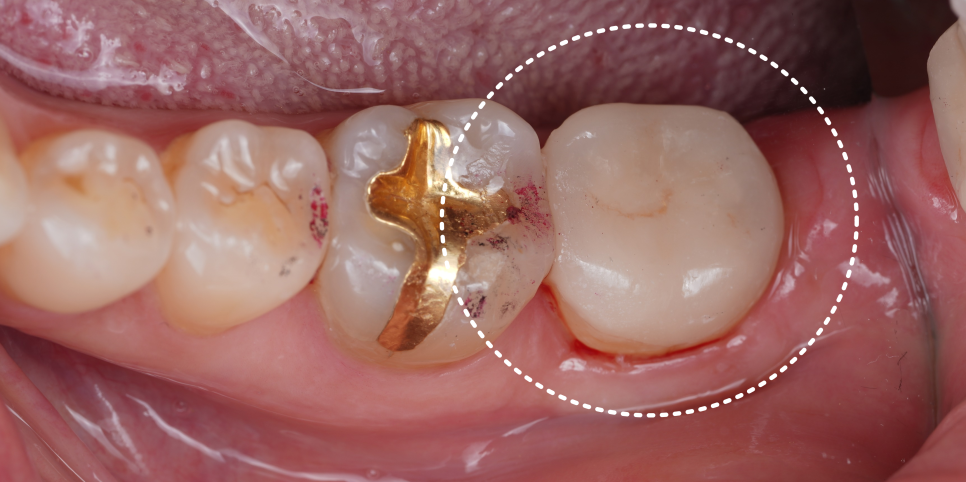 Gangnam Dental Clinic: You Wanted an Extraction, but We Preserved the Tooth with Root Canal Treatment + Overlay image 16