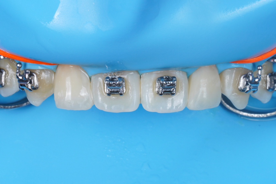 왜소치 레진 비니어, 교정 마무리 할 때 오시면 참 좋습니다. 관련 이미지 5