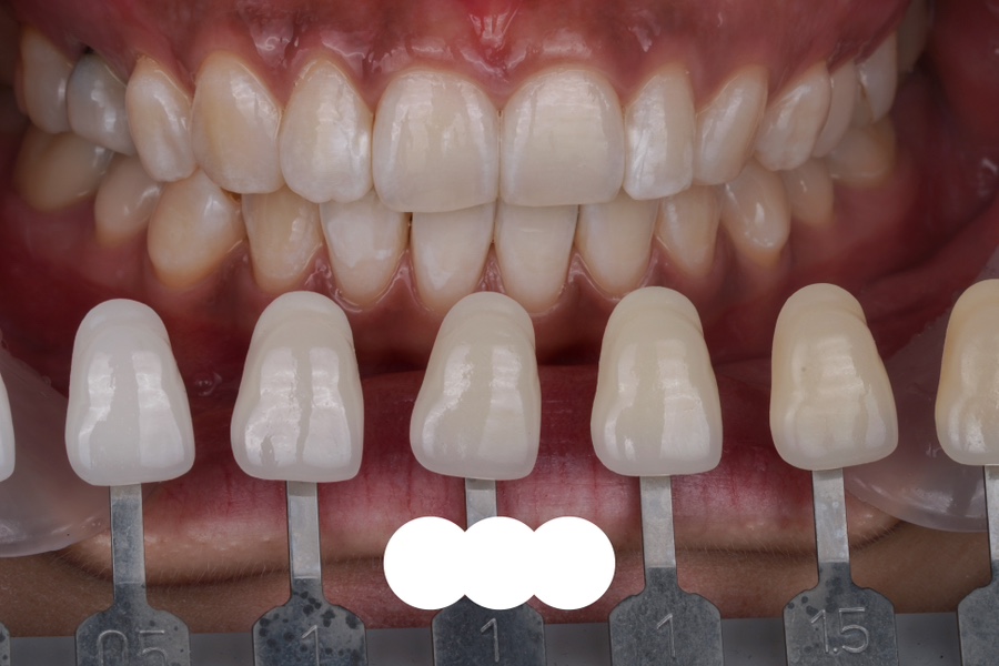 역삼동 치과는 응급실이 아니예요, 원데이 치아미백으로 만드는 환한 미소 관련 이미지 3