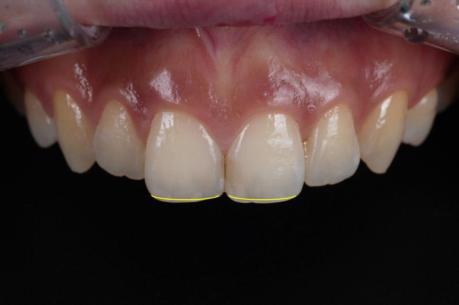 앞니사이충치 레진으로 치아성형 효과까지 낼 수 있어요 관련 이미지 4