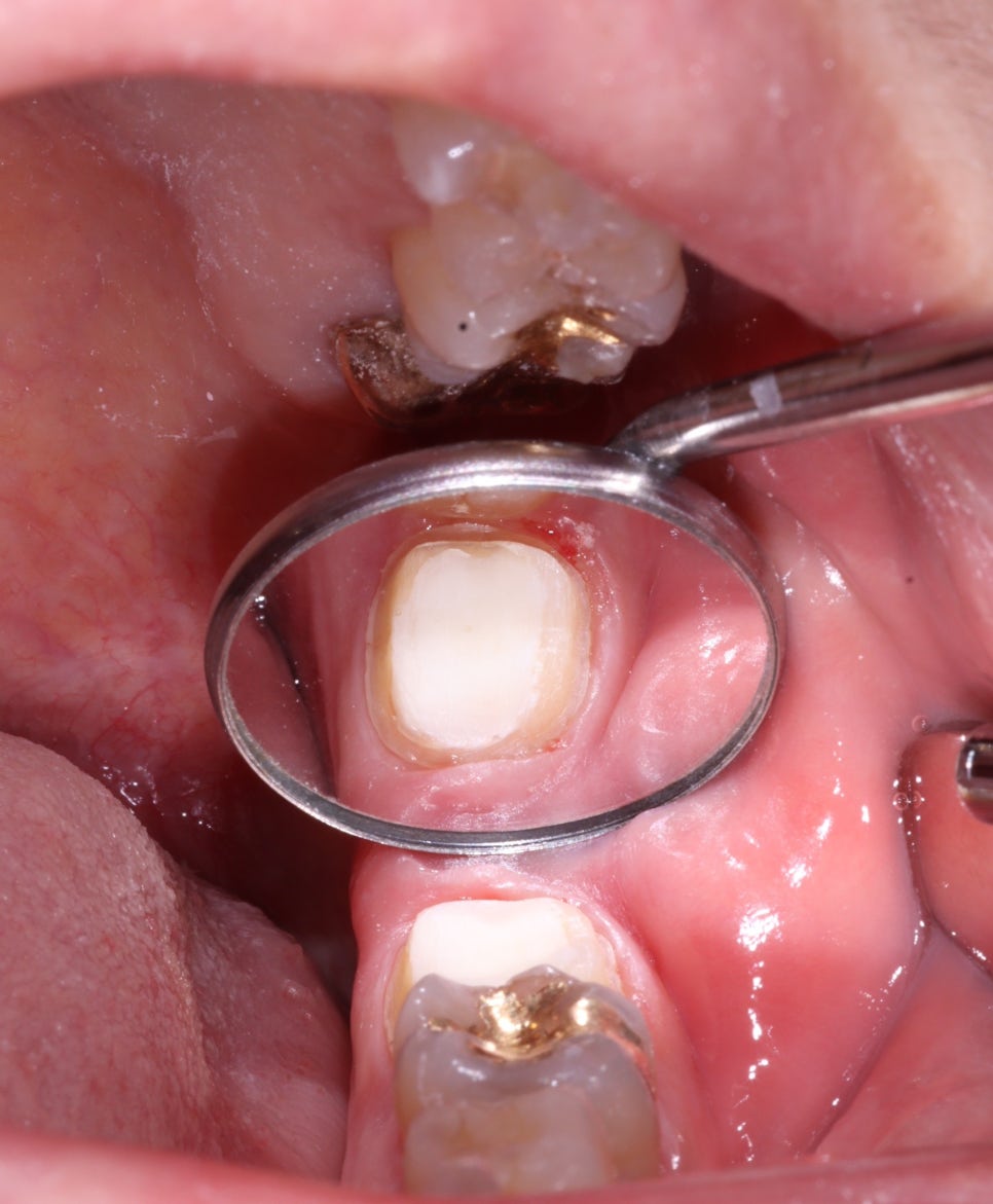 교대역 어금니 크랙 깨짐으로 씹을때 통증, 발치 피하고 신경치료로 유지한 케이스 관련 이미지 8