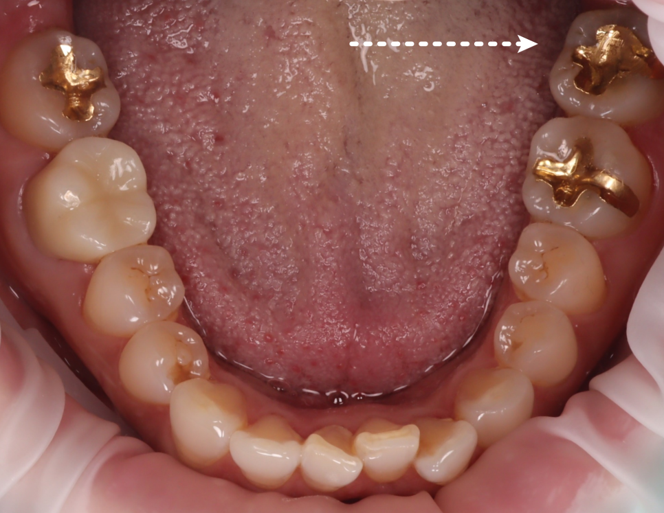Gangnam Dental Clinic: You Wanted an Extraction, but We Preserved the Tooth with Root Canal Treatment + Overlay image 5