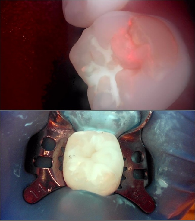 Jamnwon-dong Dental Clinic: Don’t Grind Down Your Teeth—Get Resin Build-up Instead image 12