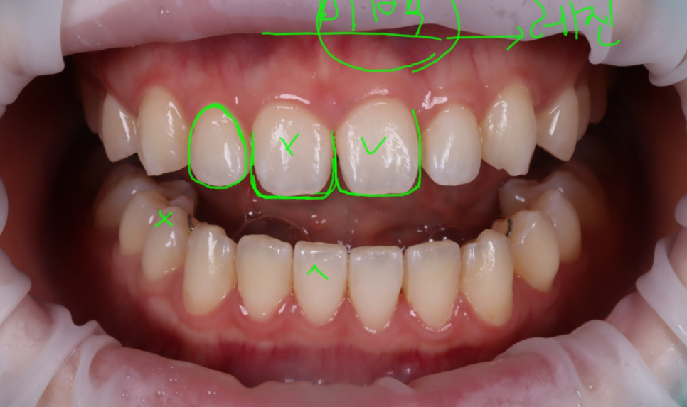 앞니 벌어짐 레진 비니어 후 미인대회 출전 관련 이미지 5