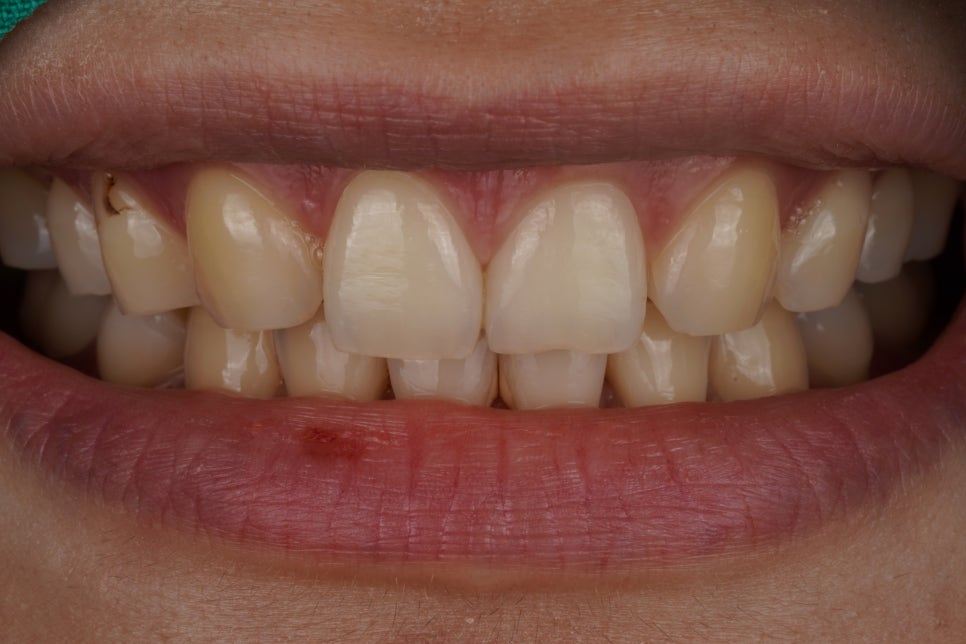 앞니살짝깨짐 치아성형은 역시 교대역 재주좋은 치과 관련 이미지 3