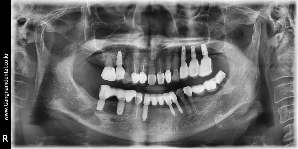 야, 너두 임플란트 할 수 있어 <책> 김영삼 원장의 임플란트 달인되기 관련 이미지 1