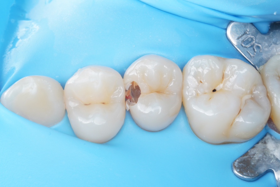 신경치료 할법한 어금니를 레진 빌드업으로 살려가는 이유 관련 이미지 5