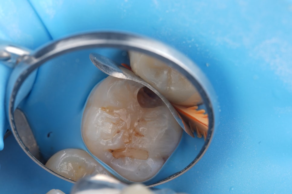Do Cavities Between Teeth at Sinsa Station Dental Clinic Have to Be Treated with an Inlay? Resin Is Also an Option image 11