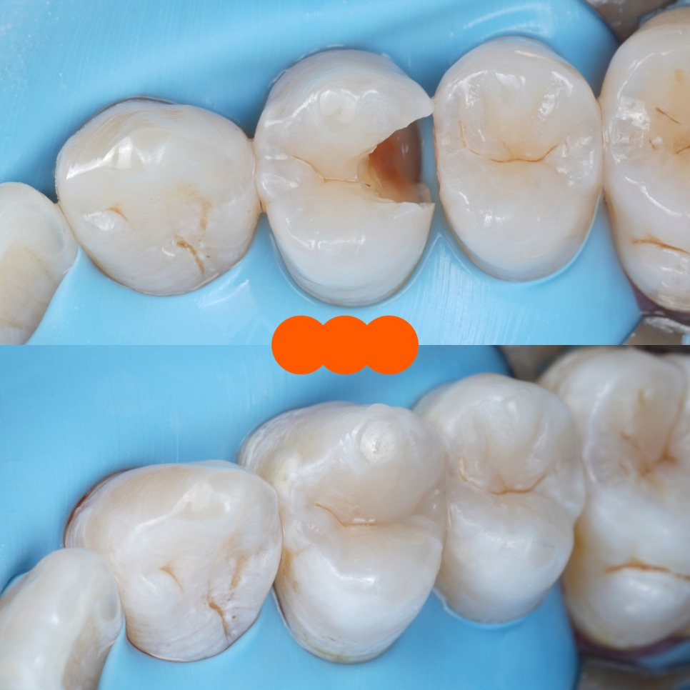 강남역치과 치료 부위 2차 충치 레진 재치료 사례 관련 이미지 12