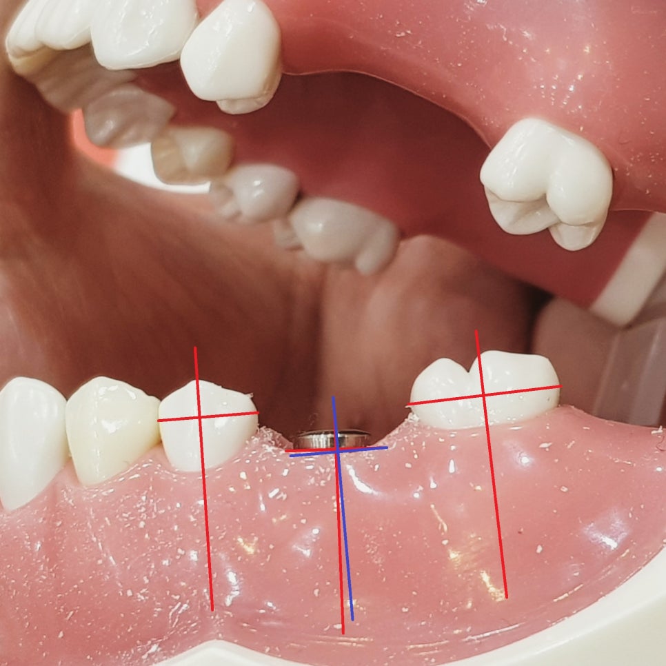 20년5월30일 / 김영삼원장님 임플란트 모델실습 관련 이미지 2