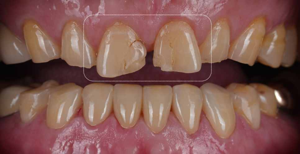 신논현역치과 심하게 마모된 60대 남성 앞니 크라운 치료 관련 이미지 12