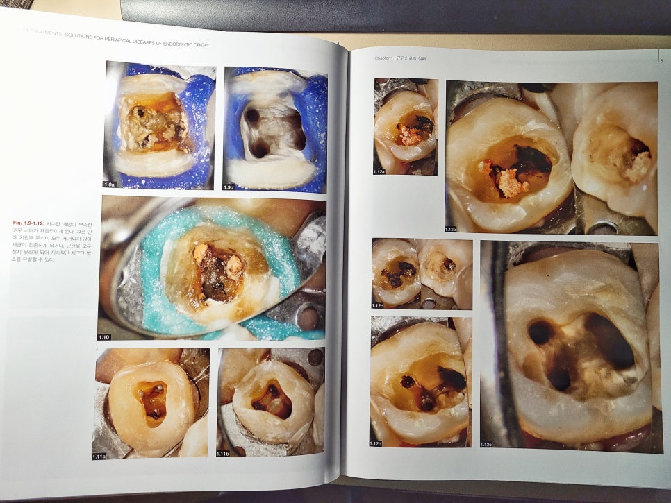 <책> 재근관치료 - 치수기원 치근단 병소의 치료 관련 이미지 2