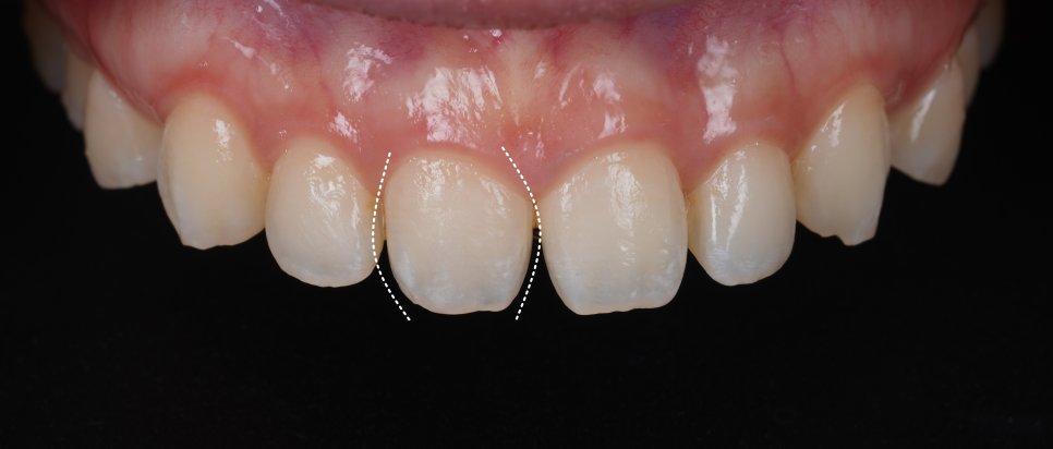 앞니 벌어짐 레진 비니어 후 미인대회 출전 관련 이미지 2