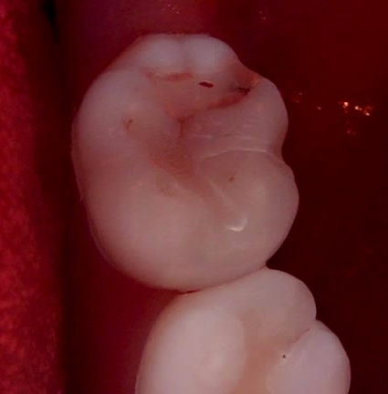 교대역 치과 보철 아래 2차 충치를 다시 레진으로 관련 이미지 16