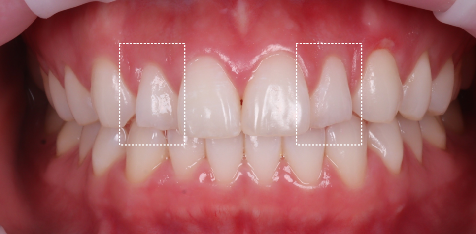 If Your Front Teeth Look Extra Large, Be Sure to Read This — Gyodae Station Dental Clinic image 2
