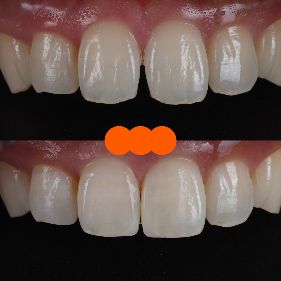 방배동치과 누렇고 벌어진 치아 미백과 레진 치료 관련 이미지 13