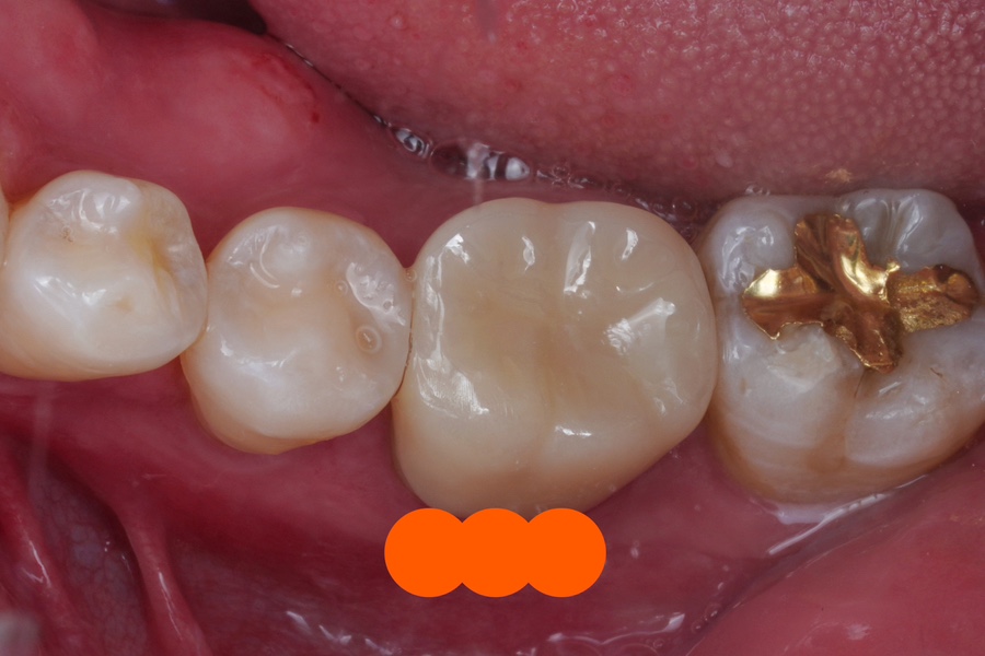 신경치료 할법한 어금니를 레진 빌드업으로 살려가는 이유 관련 이미지 9