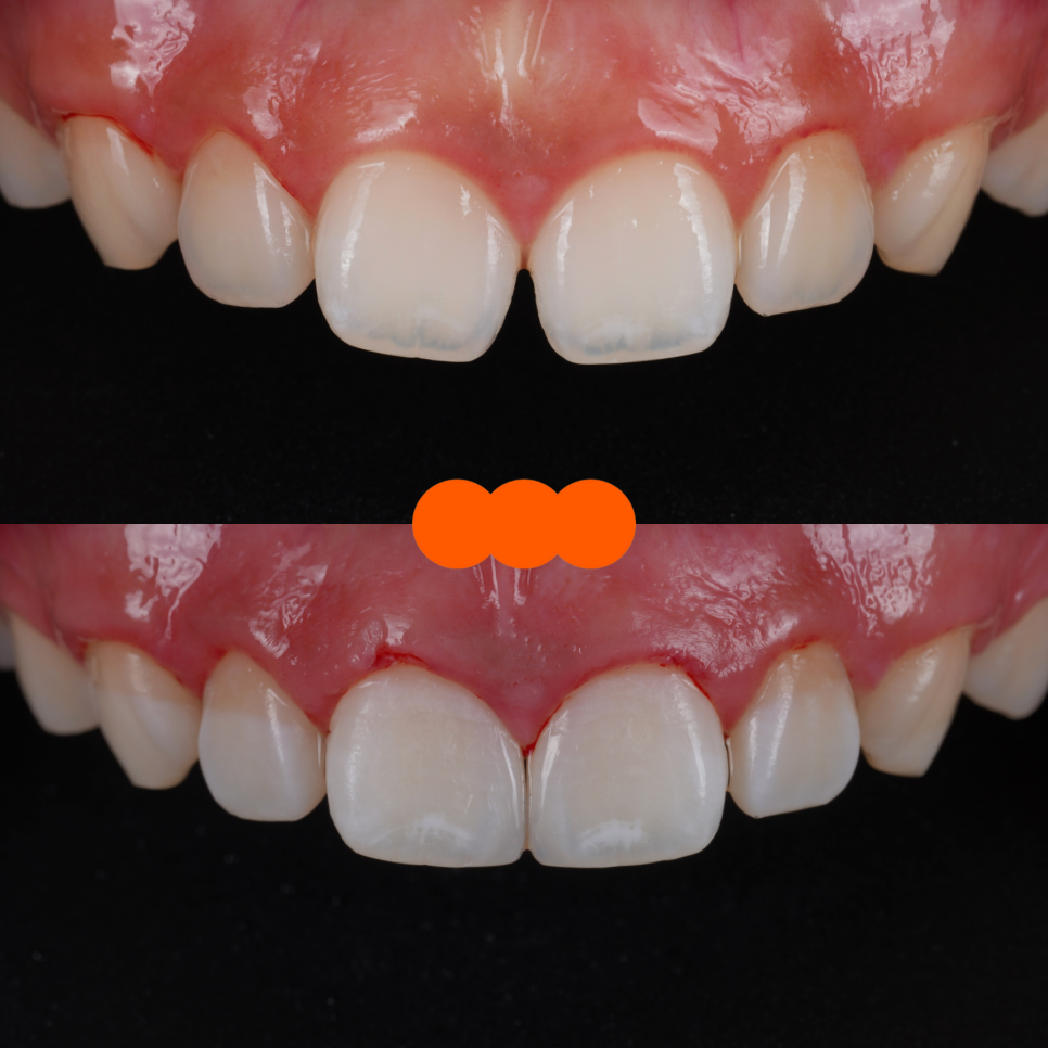 방배동치과 앞니 벌어짐 해결하러 강릉에서 오셨어요 관련 이미지 13