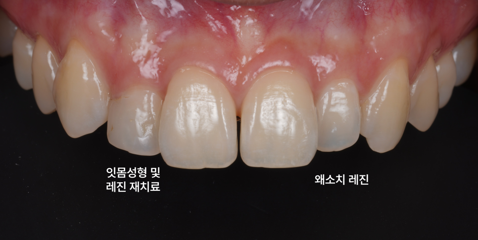 왜소치레진 20년 전에 했던 치아 재치료 후 반대쪽까지 관련 이미지 9