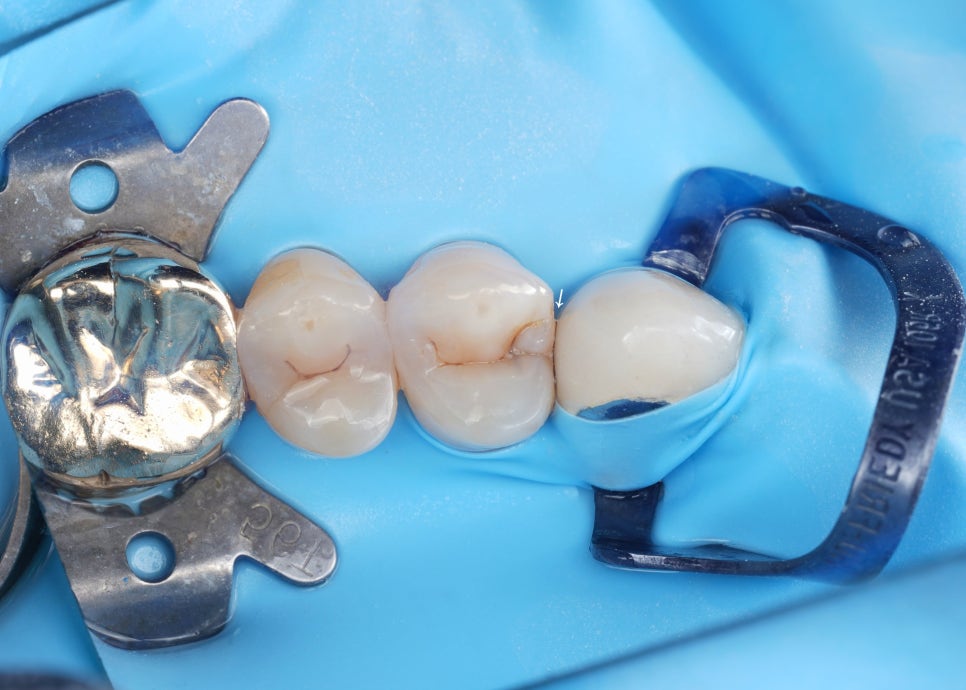 치아 사이 충치를 치료하는 방법, 레진과 인레이 비교 관련 이미지 1